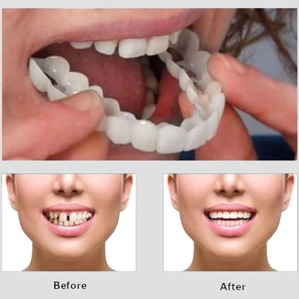 Snap-On Smile – Instant Smile Enhancement Teeth Veneers | Natural-Look Cosmetic Dental Cover