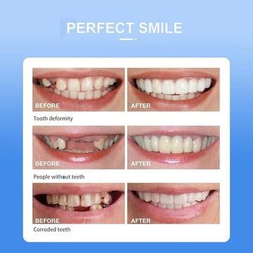 Snap-On Smile – Instant Smile Enhancement Teeth Veneers | Natural-Look Cosmetic Dental Cover
